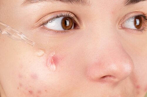 Tulehdus - Fruktoosi lisää tulehdusriskiä – Näin vähennät sen vaikutuksia terveyteesi